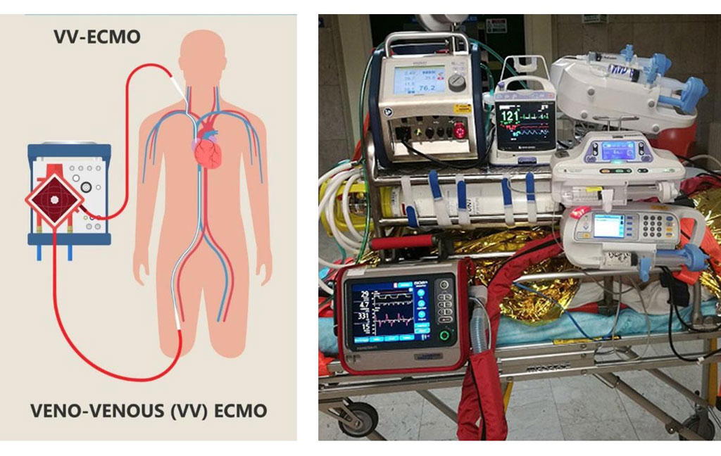 Sanità, Germaneto rafforza l’eccellenza ECMO: approvato il nuovo percorso salvavita H24
