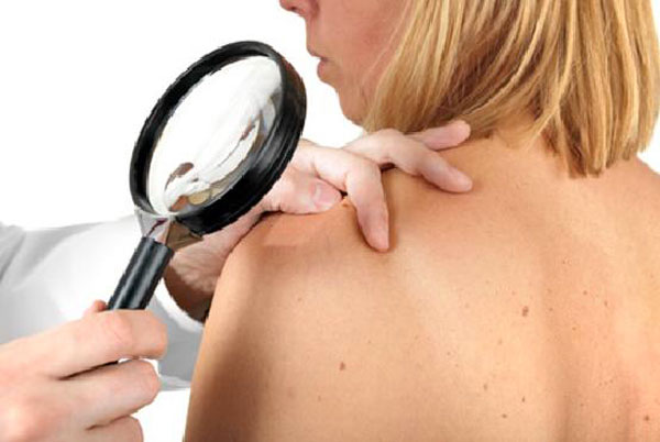 "Un mare di prevenzione", il 6 campagna Lilt su prevenzione melanoma a Crotone