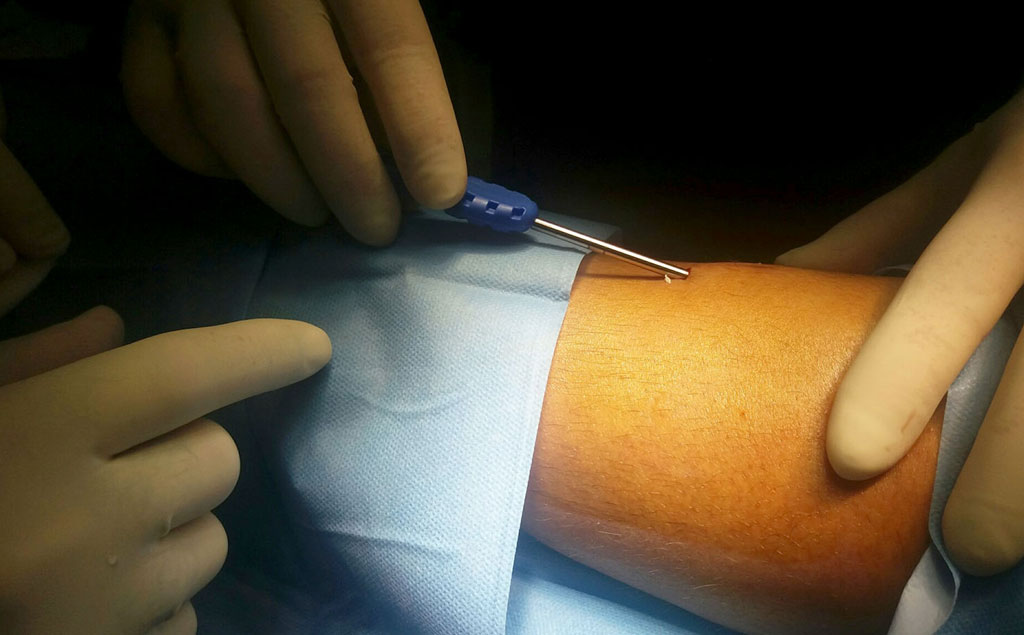 Lamezia, impiantato sensore sottocutaneo per monitoraggio continuo della glicemia in tre giovani diabetici