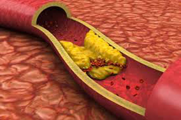 All’UMG di Catanzaro scoperto uno dei meccanismi responsabili delle stenosi arteriose nell’arteropatia periferica