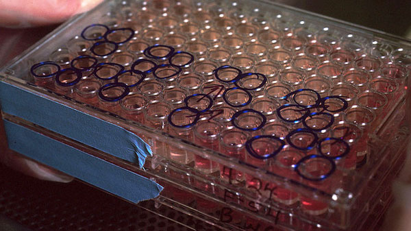 Covid, al via anche a Vibo Valentia terapia con anticorpi monoclonali