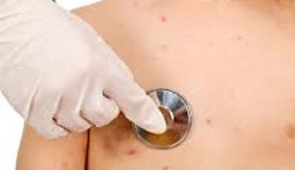 Morbillo, in Calabria segnalati l'80% dei casi