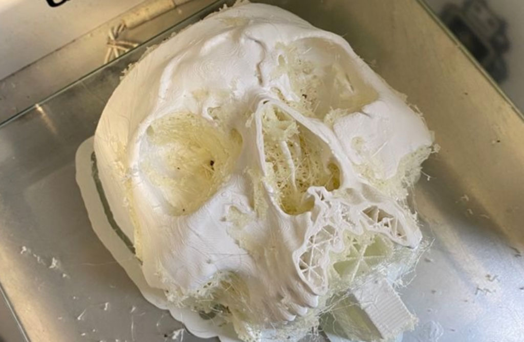 Chirurgo plastico calabrese ricostruisce volto con stampa 3D a Torino